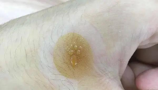 灸花，一種奇妙的花