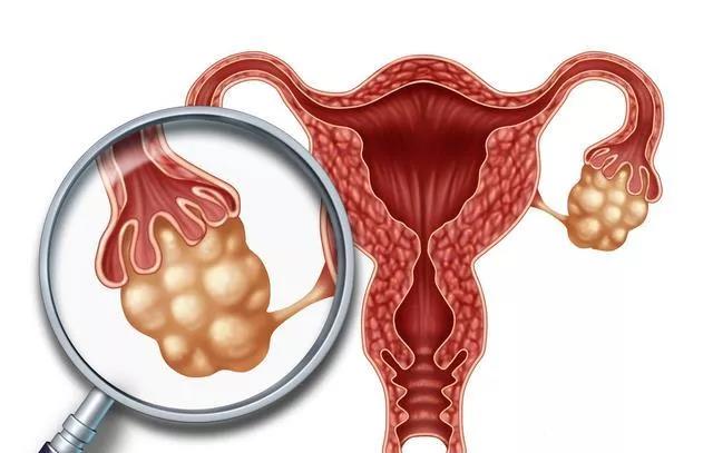 婦科“第一兇癌”！當出現這些癥狀時(shí)，婦科問(wèn)題艾灸灸什么穴位