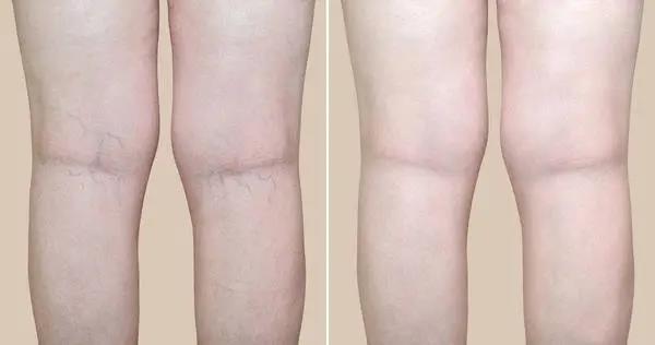 人老腳先衰，木枯根先竭，艾灸不能忘了灸腿！