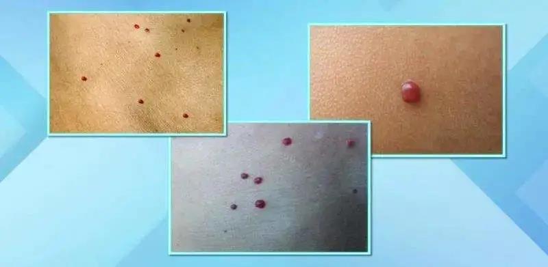 身上莫名其妙的出現血痣，怎么辦？